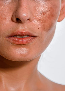 Melasma